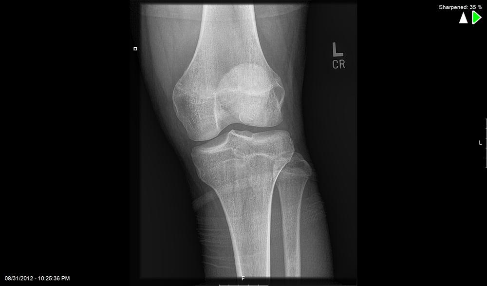 Articular Cartilage Defects of Knee Knee & Sports Orthobullets